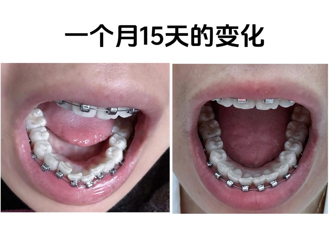 上海38岁做牙齿矫正晚不晚 过来人告诉你真实经历
