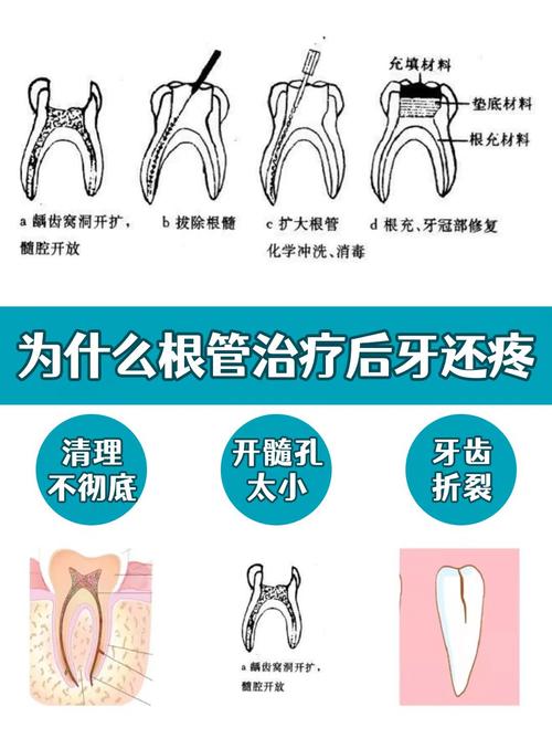 上海根管治疗是种牙吗 别再混淆两者天差地别