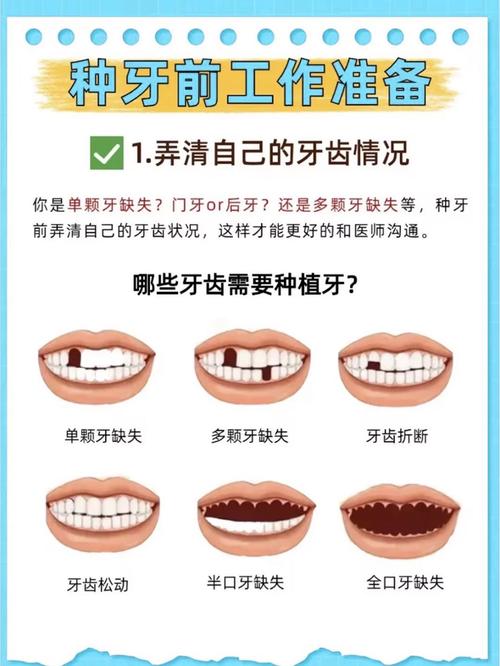 满口种牙_种满口牙好不好_牙满口种植