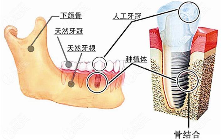 上海深圳瑞士ITI种植牙 牙槽骨条件要求详解