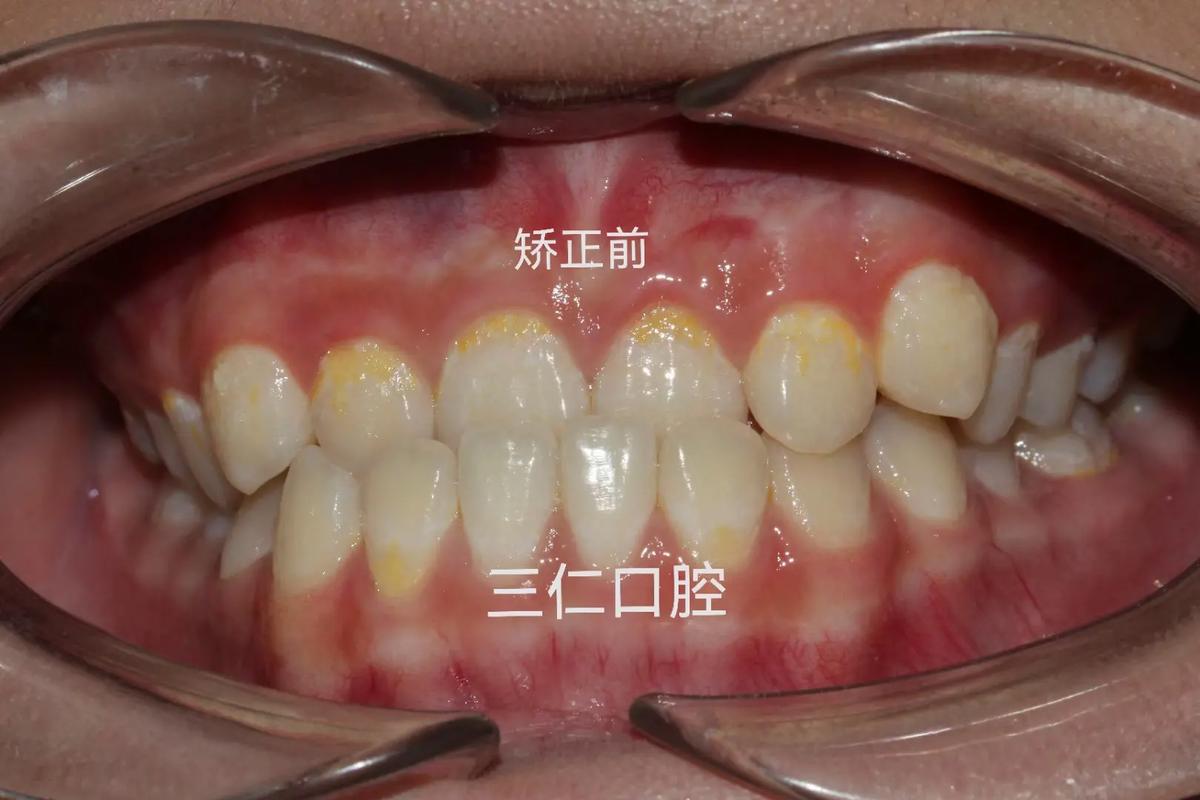 上海种一颗牙矫正价格是多少 看完这篇心里有数