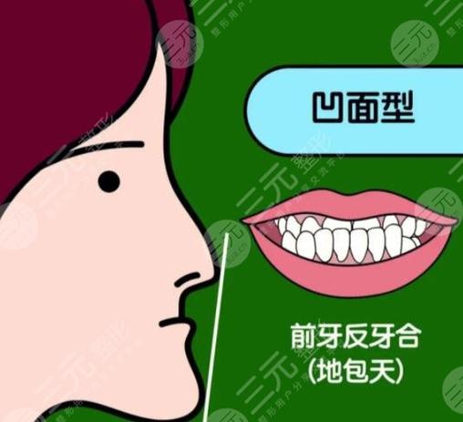 上海深圳儿童地包天矫正多少钱？2026最新价格表来了
