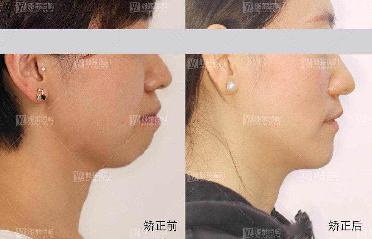 上海矫正牙齿对脸型的改变到底有多大？真实对比告诉你