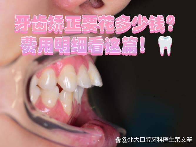 上海广州牙齿矫正到底要花多少钱?看完这篇不踩坑