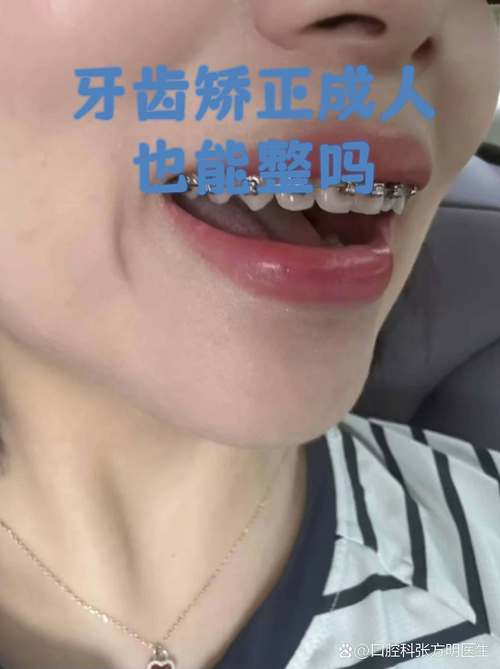 上海成人地包天牙齿矫正 成年人还能做吗效果好吗
