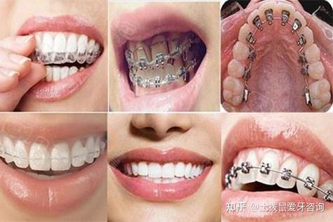 上海34岁做牙齿矫正还来得及吗
