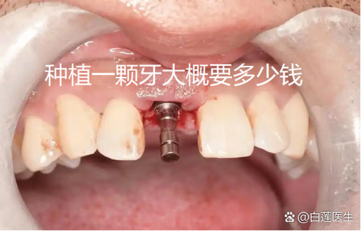 上海纯钛种牙多少钱一颗?费用明细和影响因素都在这里