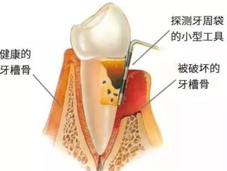上海深圳牙槽骨太薄种牙有救吗？医生说实话