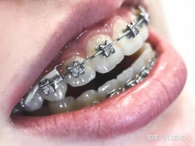 上海矫正牙齿到底要花多少钱