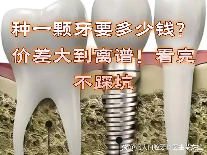 2025年种一颗牙多少钱_26年种牙价格_2026年种牙多少钱