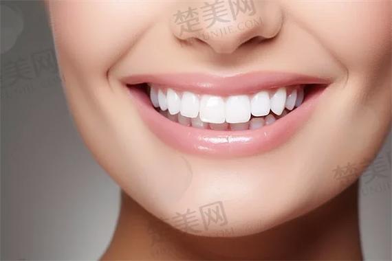 上海杭州自锁牙齿矫正多少钱？真实费用全揭秘