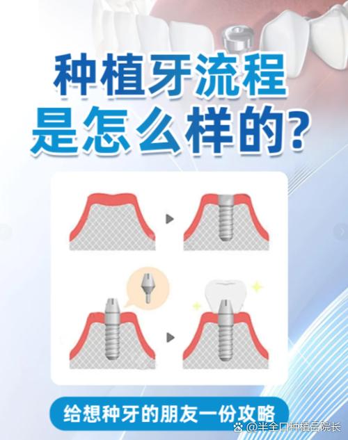 上海上门牙种牙要多久 门牙种植美观又牢固