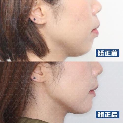 上海35岁牙齿还能矫正吗 成人矫正效果看这里