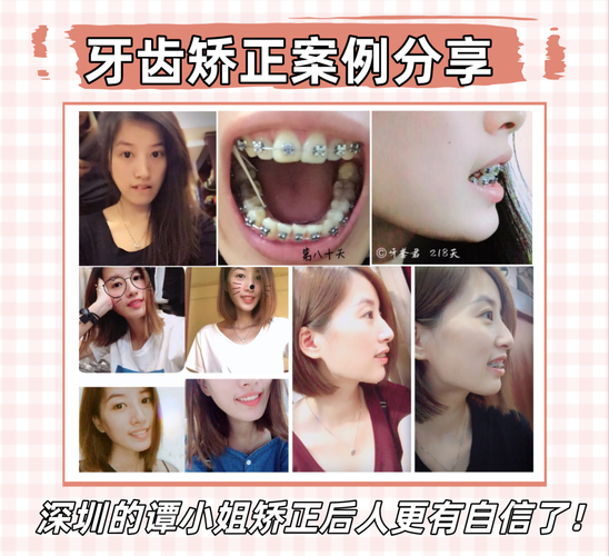 地包天矫正价格_地包天矫正成深覆合了_深圳福田地包天矫正多少钱