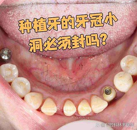 上海深圳龙华全口种植牙当天戴牙冠,靠谱吗?