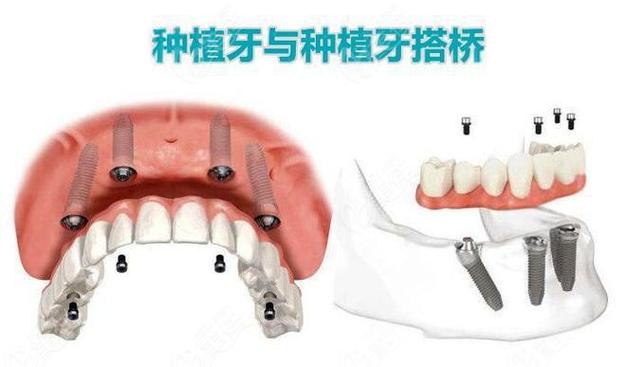 上海种植牙还是搭桥哪个更好