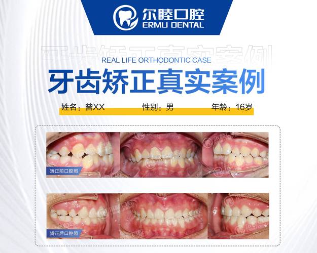上海深圳宝安换牙矫正多少钱？各项目详细价格参考