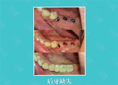 上海龙岗中心城种植牙医院怎么选 本地人的真实推荐
