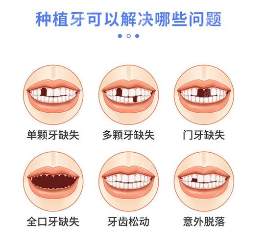 上海宝安新安种植牙哪家医院好？靠谱选择看这几点