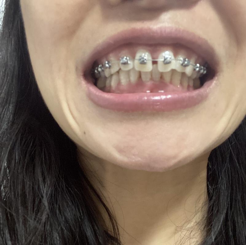 上海40岁还能矫正牙齿吗？真实案例告诉你答案