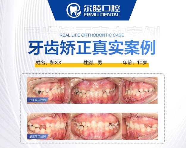 上海深圳龙华钢丝矫正哪里好？选对牙科很关键