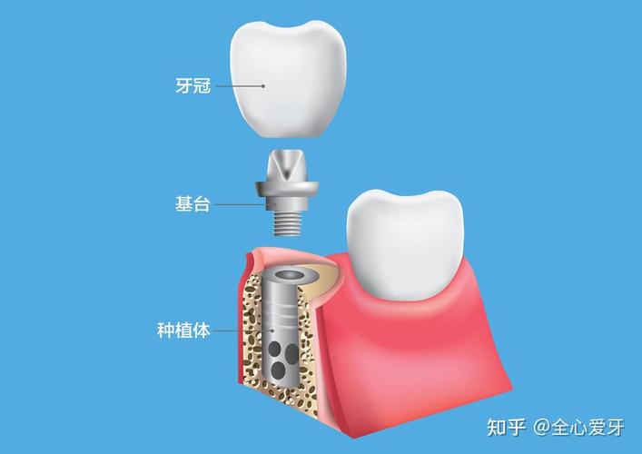 上海青岛种牙集采后 韩系奥齿泰套餐多少钱