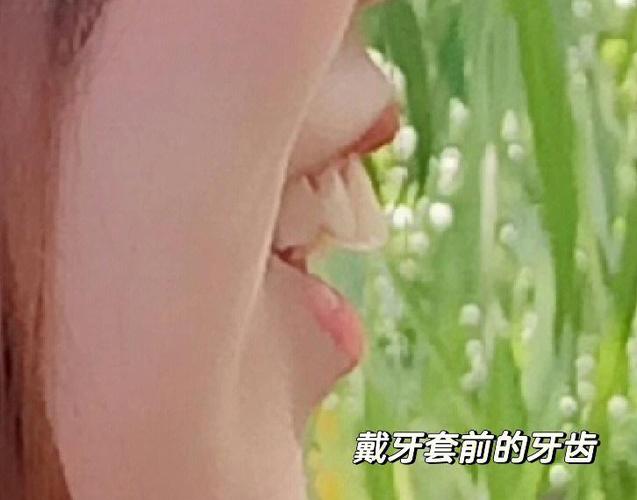 上海深圳骨性龅牙正畸选哪家医院?骨科正畸避坑全攻略