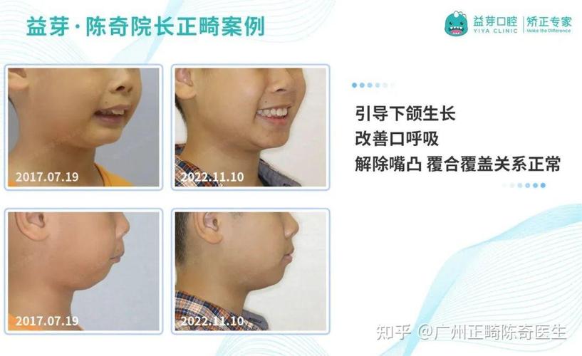 上海东莞儿童牙齿矫正几岁开始最好？家长别等换完牙才后悔