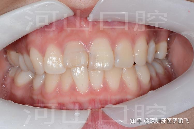 上海20岁牙齿还能不能矫正？成年人正畸真实情况揭秘