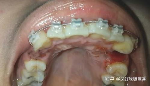 上海宁波青少年牙齿矫正选哪家？费用多少？看完这篇就明白