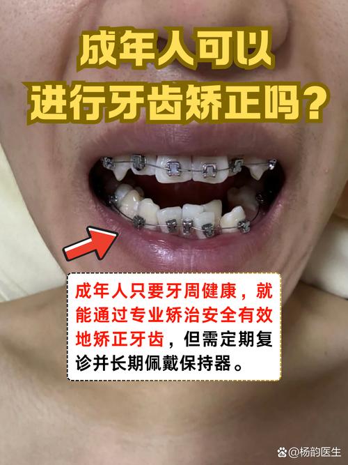 上海30岁矫正牙齿还来得及吗 成年人正畸必看