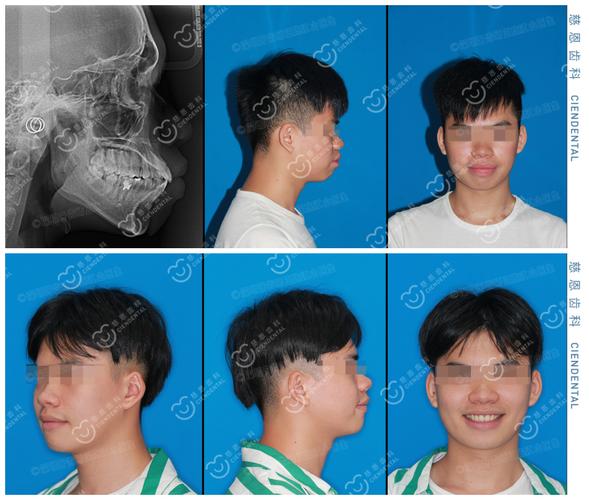 上海深圳罗湖骨性龅牙隐形矫正能行吗?方案详解