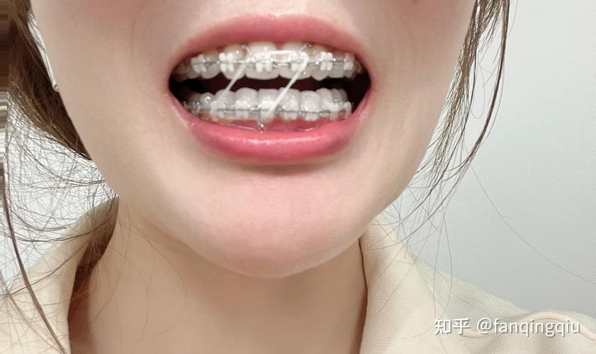 上海27岁做牙齿矫正还来得及吗