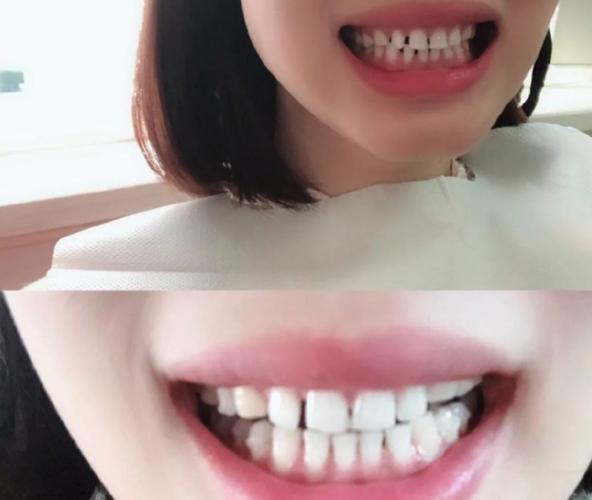 上海成都钢丝矫正牙齿要多少钱？真实价格全曝光