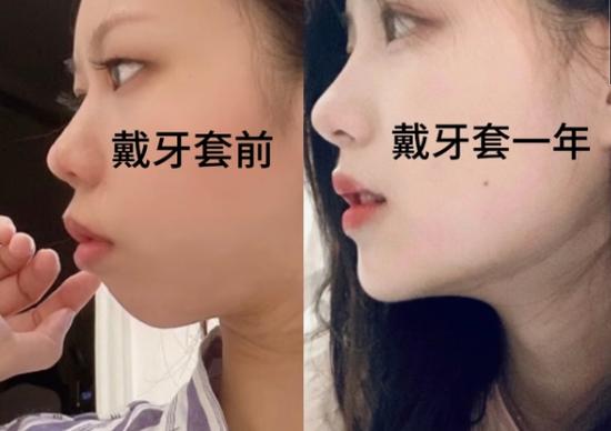 免费咨询上海牙齿矫正_上海牙齿矫正方案_上海矫正牙齿的好处