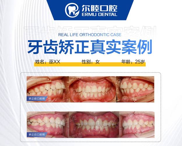 上海深圳宝安金属自锁托槽矫正哪里好？公立和私立医院怎么选