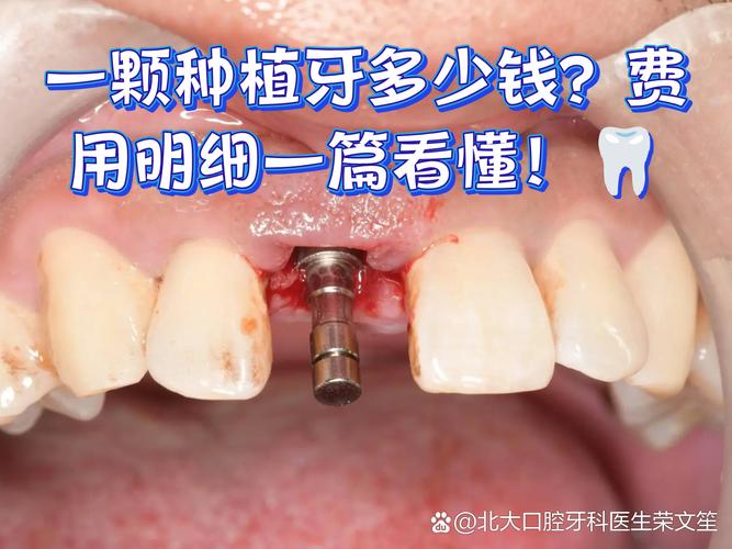 深圳诺贝尔种植牙门诊价格_诺贝尔牙科种植牙价格_诺贝尔种植牙售后服务电话