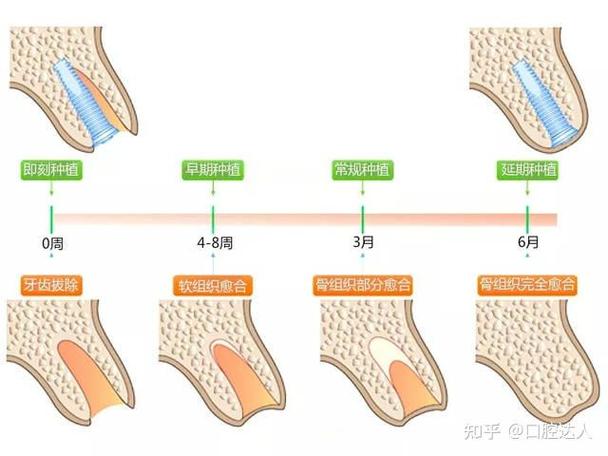 上海掉3颗牙怎样种植？种牙流程全解析+费用避坑指南