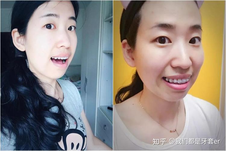 上海30岁做牙齿矫正晚不晚？真实情况告诉你