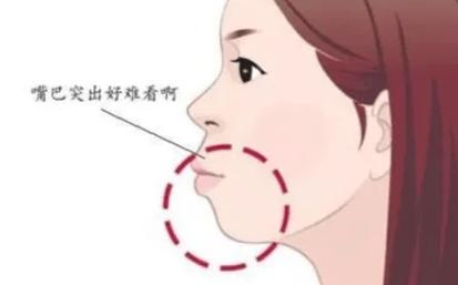 上海正颌手术前必读：矫正牙齿正颌全过程详解