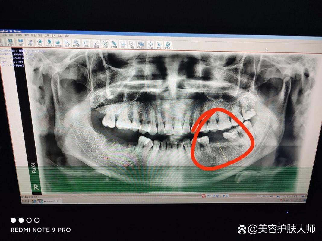 上海深圳皓圣种植牙医院靠谱吗 真实推荐指南