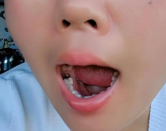 上海55岁种牙好还是镶牙好？一文告诉你答案