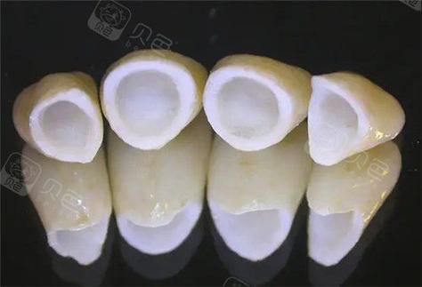 上海深圳做全瓷牙到底要花多少钱？2026年最新报价揭秘