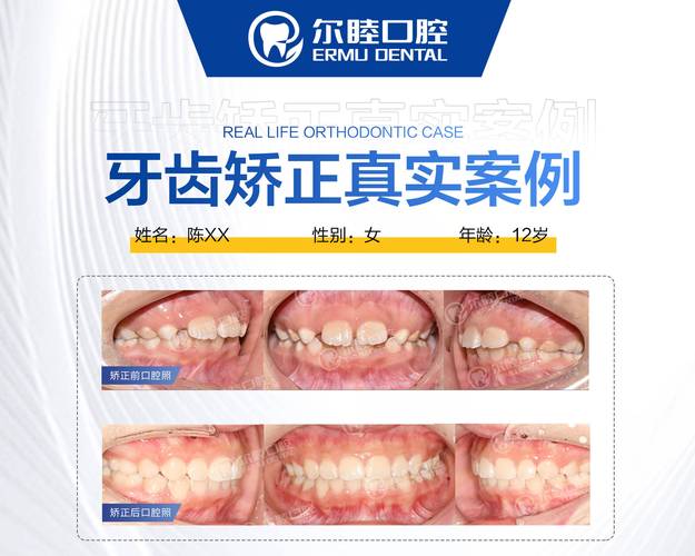 上海深圳西乡牙齿矫正费用到底要多少钱？2026年最新价格参考