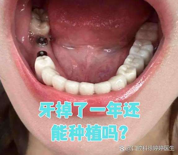上海牙齿掉了还能种吗?现在种牙靠谱不靠谱