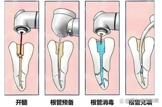 上海种牙要等多久 最佳种牙时间全知道