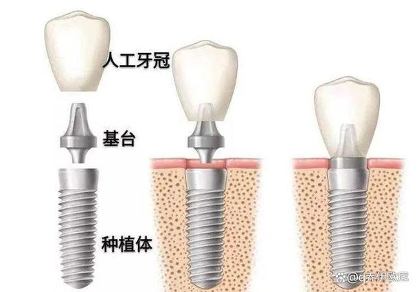上海集采种牙和自费种牙到底差在哪