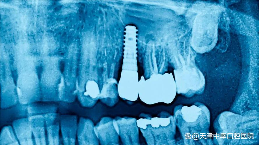 上海深圳罗湖骨量不足全口种牙到底要花多少钱