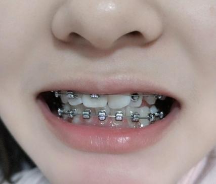 上海30岁做牙齿矫正有什么后遗症?看完这篇不踩坑