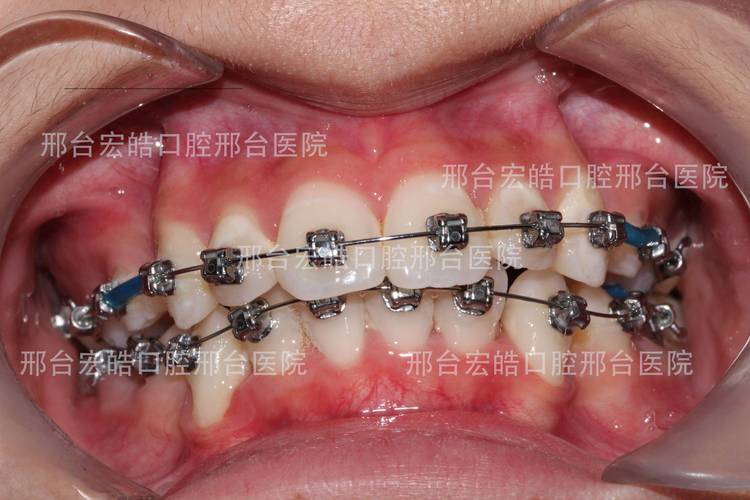 上海不整齐牙齿矫正到底要花多少钱？大概多久能好？